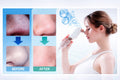 ClearPore™ Blackhead Remover Vacuum – Deep Pore Cleansing & Acne Suction Tool